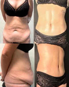 Lipoaddominoplastica Napoli - Mommy Makeover - Dr Carmine Mele