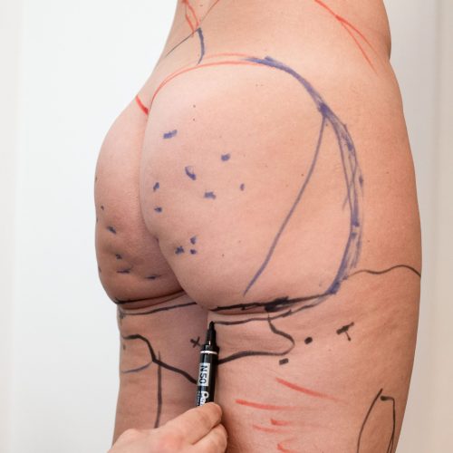 Lifting Cosce,Liposuzione Napoli, Liposuzione HD Napoli