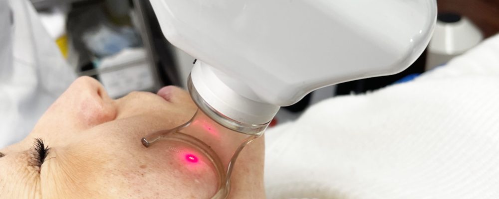 Peeling Laser