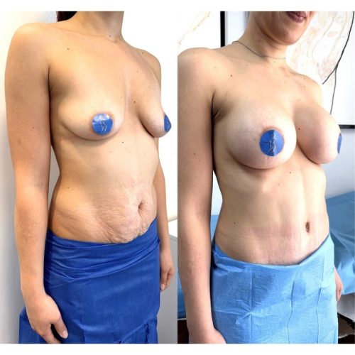 Mommy Makeover - Dr Carmine Mele - Lipoaddominoplastica