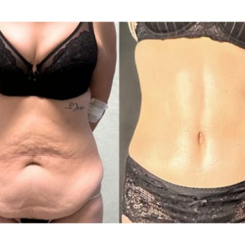 Lipoaddominoplastica Napoli – Mommy Makeover – Dr Carmine Mele LipoaddominoplasticaNapoli - Mommy Makeover - Dr Carmine Mele