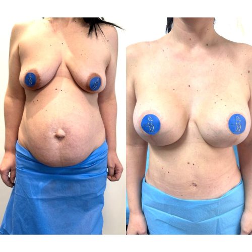 Addominoplastica, addominoplastica napoli,addominoplastica cicatrice, addominoplastica prima e dopo Chirurgo Plastico Napoli Addominoplastica Protocollo Mele Risultato Renuvion J-Plasma addome Napoli Schema riparazione diastasi dei retti Napoli Guaina compressiva post addominoplastica