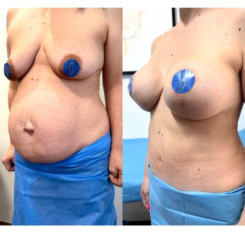 Diastasi - diastasi napoli - diastasi prima e dopo